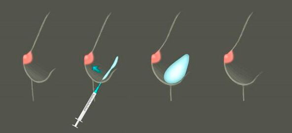 cómo se usa el hialurón para el aumento de senos