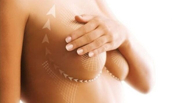 levantamiento de sutura para aumento de senos