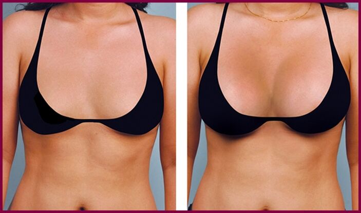 antes y después del aumento de senos con grasa