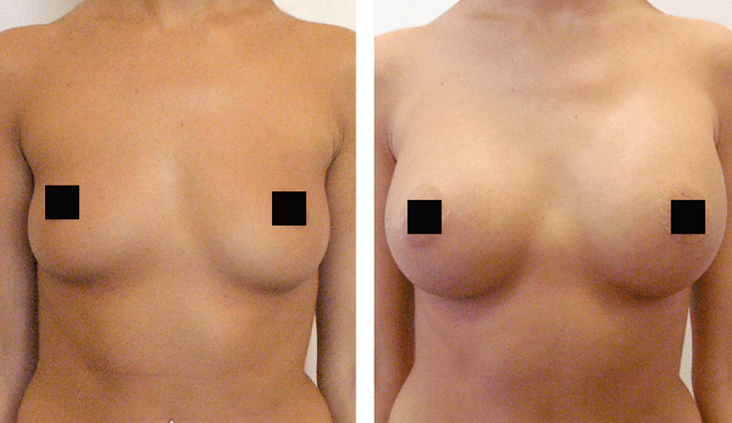 senos antes y después del aumento con ácido hialurónico