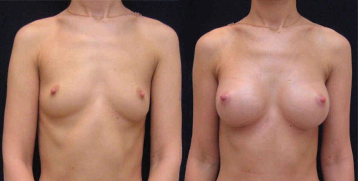 mama antes y después del aumento endoscópico
