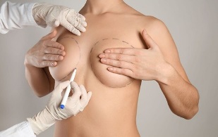 métodos de aumento de senos con cirugía