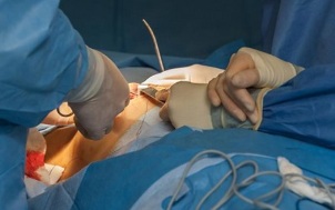 ¿Cómo se realiza la cirugía de aumento de senos 