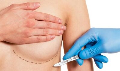 Acceso submamátrico a la agrandamiento de los senos con implantes