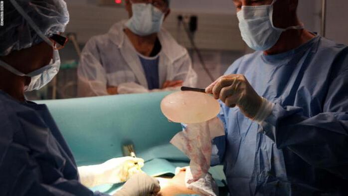Características de la mammoplastia