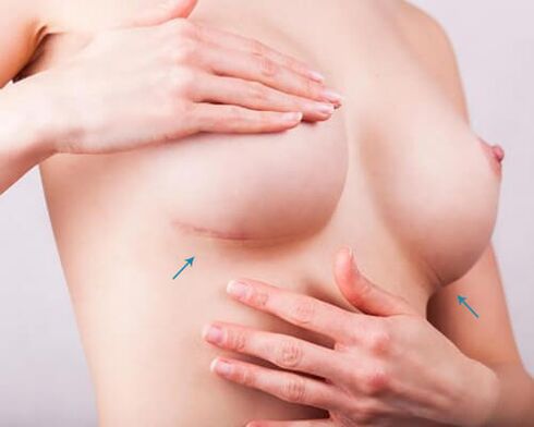 Ampliación de senos con implantes