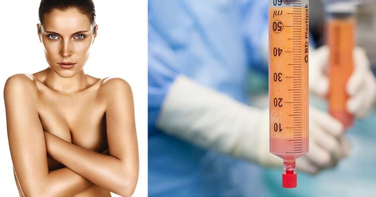 lipofilling como método de aumento de senos